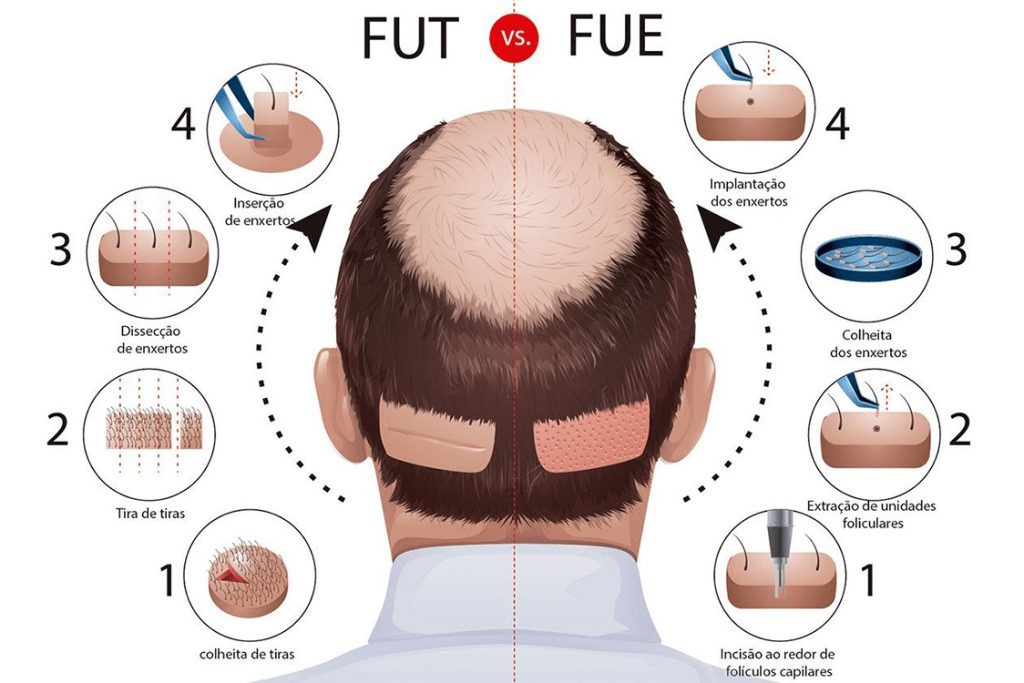 Diferenças entre a técnica FUT (follicular unit transplant) e FUE (follicular unit extraction)