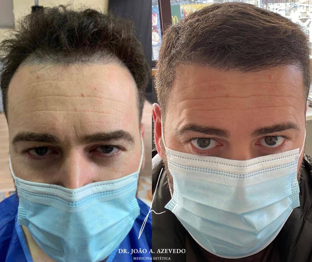 “Realizei o meu primeiro transplante na Turquia e o resultado não foi o que desejava. Estou muito satisfeito com o resultado desta cirurgia de correção. Obrigado!” -  (Nelson Sampaio)